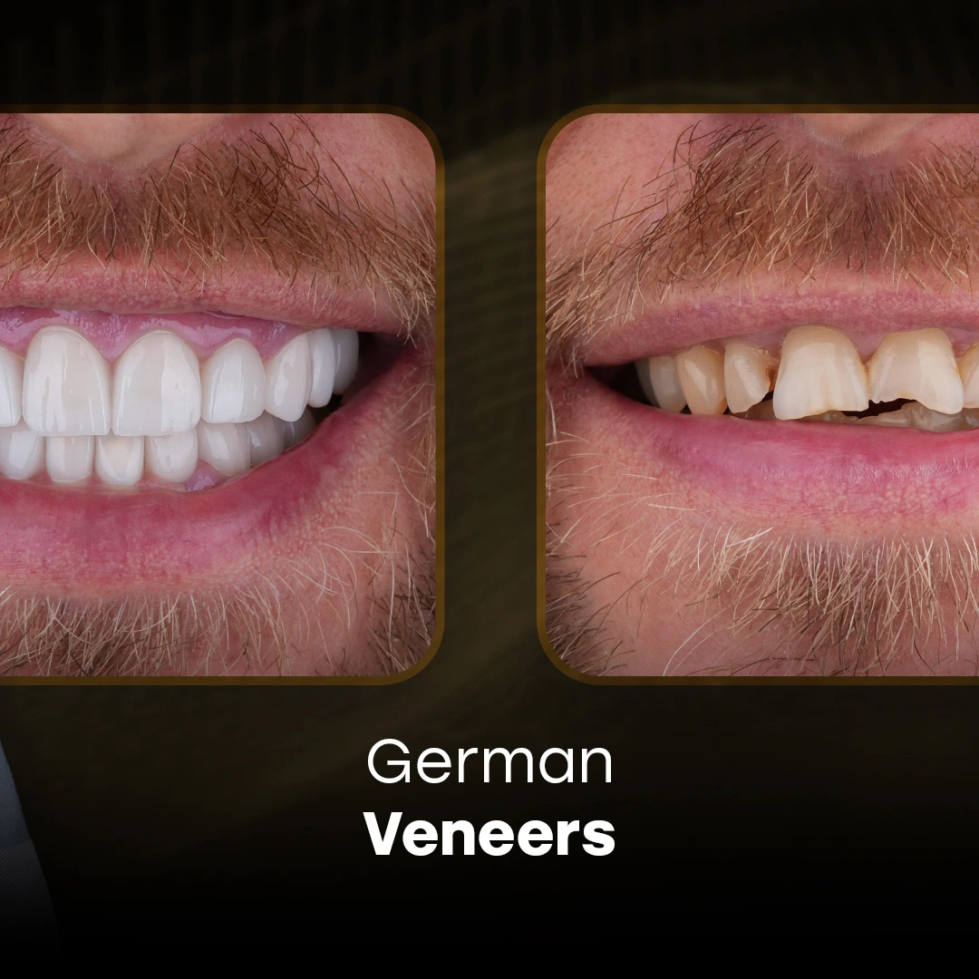 Veneers for Chipped Teeth